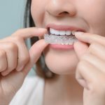 Tips Merawat Retainer Gigi Sesuai Jenisnya