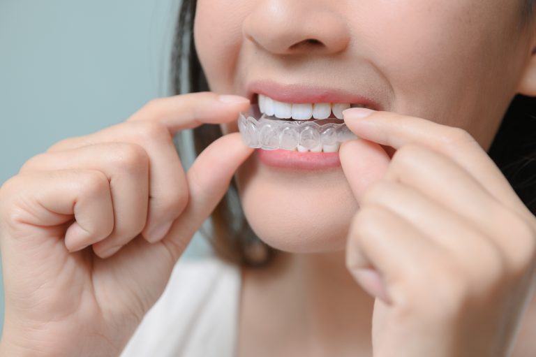Tips Merawat Retainer Gigi Sesuai Jenisnya